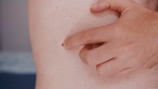 Sole e salute della pelle, i consigli per prevenire melanomi, eritemi e scottature - Edq0z-yJi8U